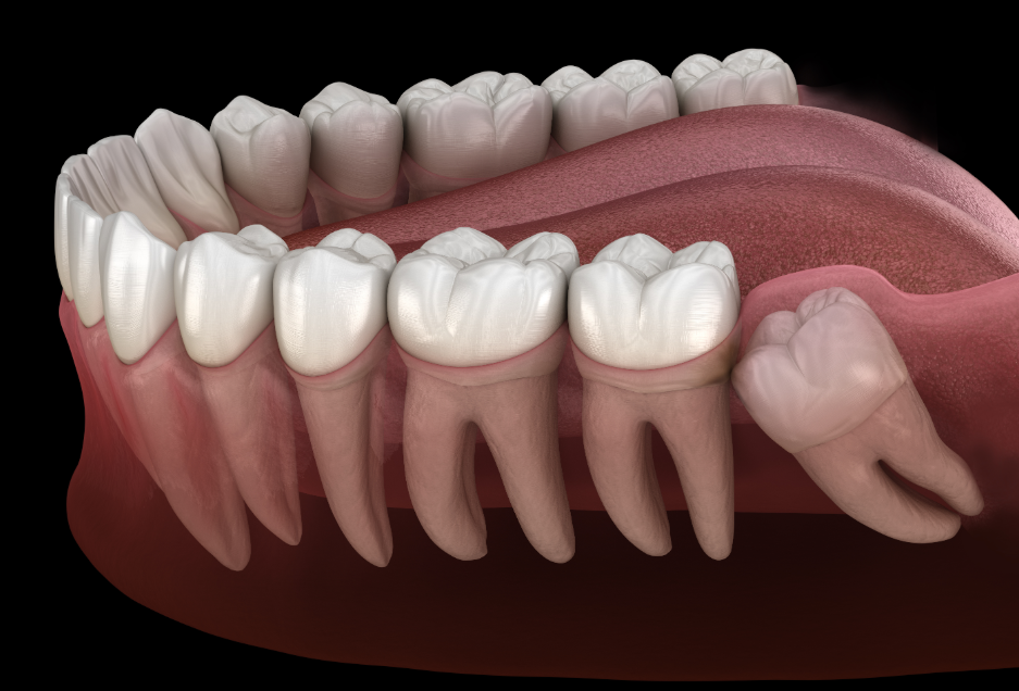 3D image of wisdom teeth
